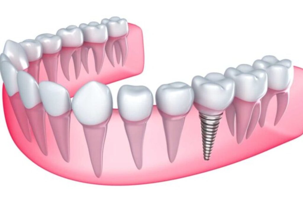 signs you may need a dental implant